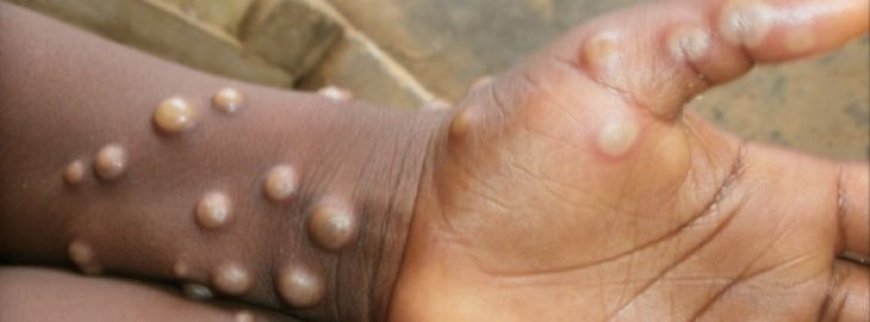 Kenya:  Umuntu wa mbere wanduye ubushita bw’inkende yajyaga mu Rwanda